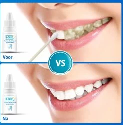 B-care Tanden Bleker – Wittere Tanden – Teeth Whitening Strips – Professioneel Resultaat - Tandsteen Verwijderaar - Zonder Peroxide - Tandenbleekset - Tanden Bleken -Mondverzorging 1177x1200 3