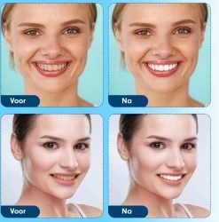 Diamond White - Teeth Whitening Strips - 28x Strips - Zonder Peroxide (0%) - Tandenbleekset - Tandenbleek Strips – Mint -Mondverzorging 1185x1200 1