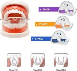 SAMA Direct™ Rechte Tanden Zonder Beugel - Orthodontische Bitjes - Rechte Tanden Bitje - Beugel - Knarsbitje - Nachtbeugel - Knarsen Bitje - Rechte Tanden - Witte Tanden