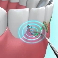 Toppers Van TV - Sonic Tandsteenverwijderaar - Tandplakverwijderaar 16 Toppers Van TV - Sonic Tandsteenverwijderaar - Tandplakverwijderaar -Mondverzorging 1200x1200 1007