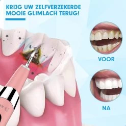 DEN-T® PRO U500 - Elektrische Sonische Tandsteen Verwijderaar - Roze -Mondverzorging 1200x1200 1042