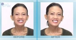 Tand Afgebroken Reparatie Kit InstantSmile Gebit (goedkope Kunstgebit) - Multi Shade 12 Tand Afgebroken Reparatie Kit InstantSmile Gebit (goedkope Kunstgebit) - Multi Shade -Mondverzorging 1200x639