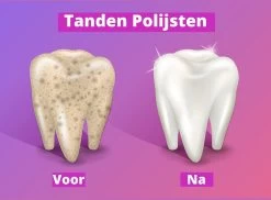 Merkloos HQ Tooth Polisher - Tanden Polijsten - Wittere Tanden - Tandsteen Tandplak Verwijderaar - Elektrisch -Mondverzorging 1200x886 2