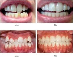 Edoir Rechte Tanden Beugel - Retainer Voor Rechte Tanden - Rechte Tanden Bitje -Mondverzorging 1200x929