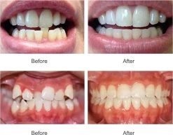 SAMA Direct™ Rechte Tanden Zonder Beugel - Orthodontische Bitjes - Rechte Tanden Bitje - Beugel - Knarsbitje - Nachtbeugel - Knarsen Bitje - Rechte Tanden - Witte Tanden -Mondverzorging 1200x938 2